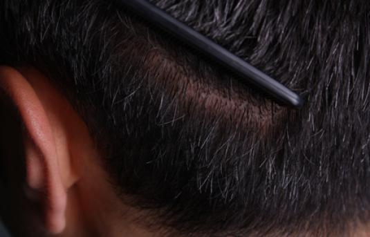 Hair Transplant&nbsp;Trichophytic Donor Scars